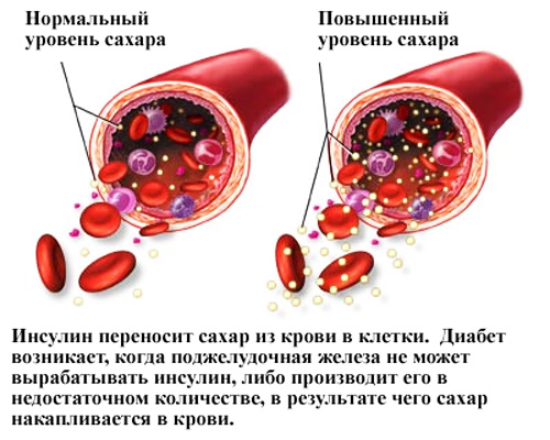 kak-vibrat-glukometr 4